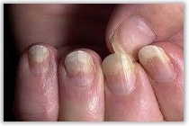 Псориаз ногтей (лечение, симптомы)